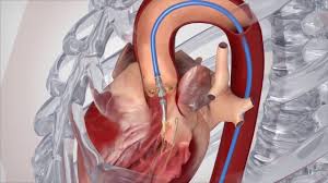 Aortic Valve Surgery at Livasa Mohali - Advanced Heart Procedures